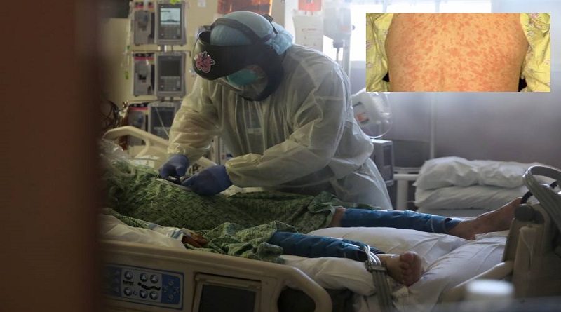 OMS advierte sobre posible vínculo de coronavirus en rara enfermedad infantil