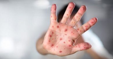 Aumenta brote de sarampión y fiebre amarilla en Brasil en medio de la Pandemia
