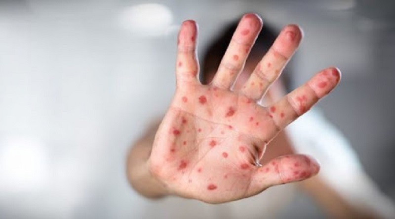 Aumenta brote de sarampión y fiebre amarilla en Brasil en medio de la Pandemia