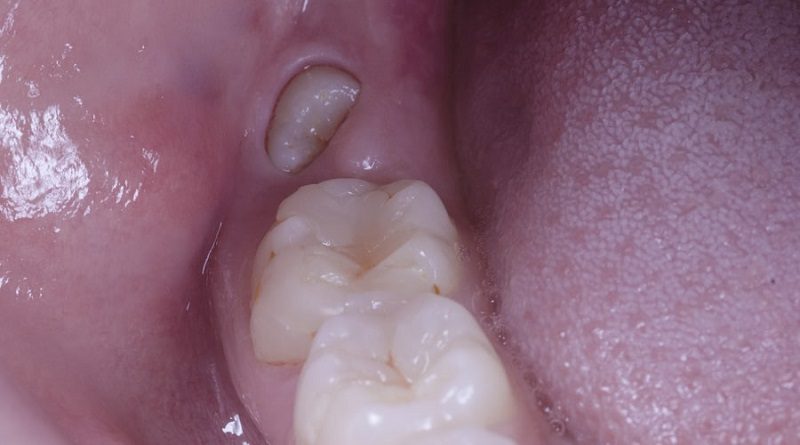 Científicos japoneses descubren cómo hacer que los dientes crezcan de nuevo