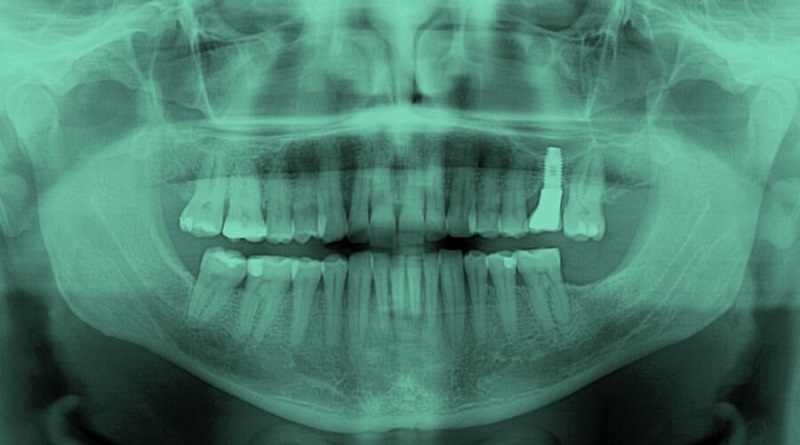 Científicos japoneses descubren cómo hacer que los dientes crezcan de nuevo