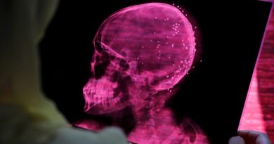 ENTÉRATE | Estudio revela que la COVID-19 altera el volumen de materia gris en el cerebro
