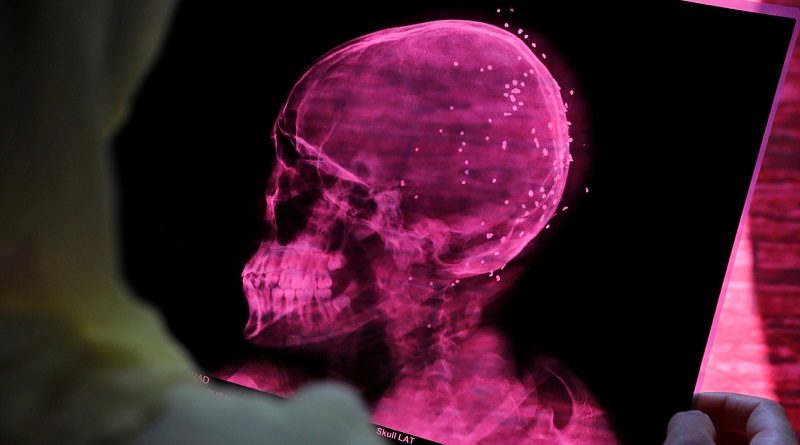 ENTÉRATE | Estudio revela que la COVID-19 altera el volumen de materia gris en el cerebro