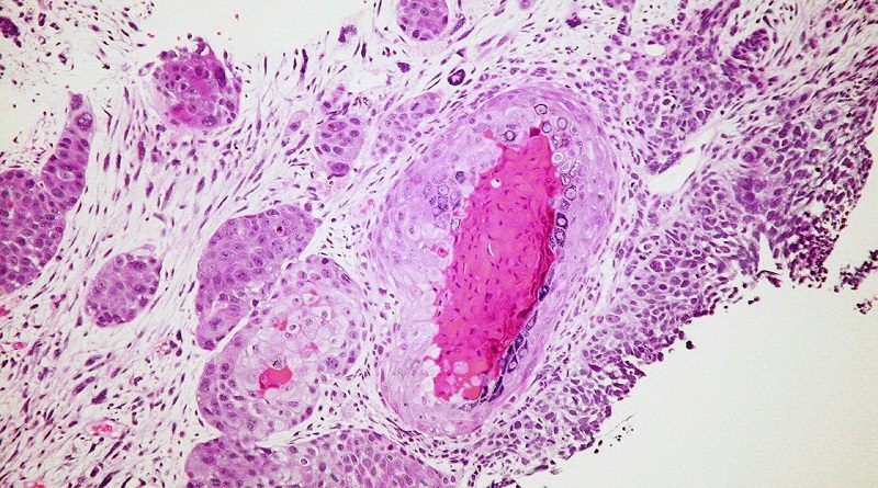Estudio revela que el cáncer de colon se puede prevenir con un fármaco psiquiátrico de uso común