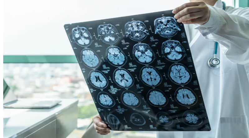 Crean una IA que predice el riesgo de alzhéimer
