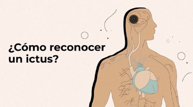 29/OCT. | Día Mundial del Ictus: Cómo detectar a tiempo un posible derrame cerebral