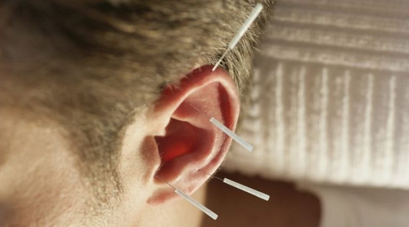 La acupuntura del oído ayuda a reducir el dolor crónico de cuello