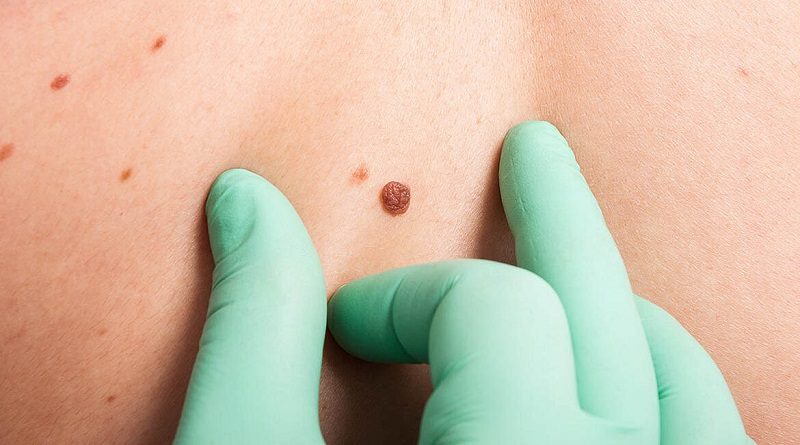 Crean dispositivo que detecta tejido canceroso en la piel