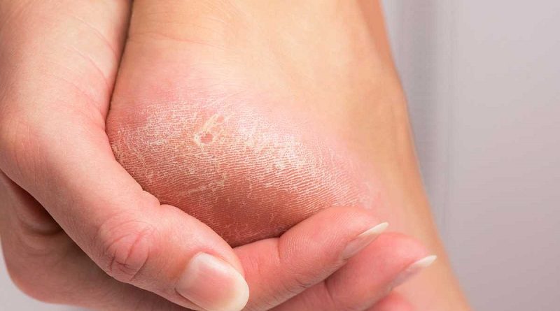 Resequedad en los pies podría estar asociada a problemas de salud