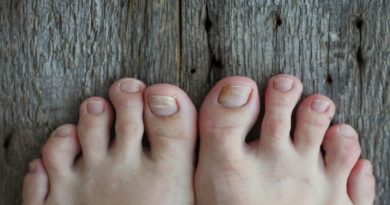 Remedios naturales para combatir hongos en la uñas