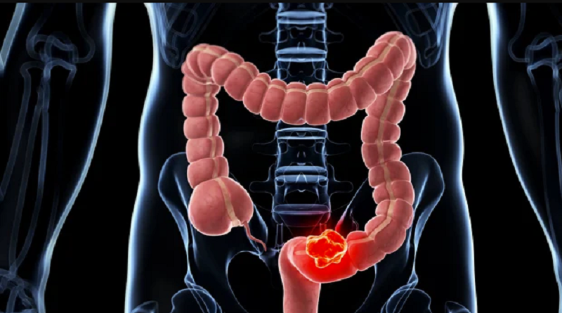 Terapia experimental logra remisión completa del cáncer de colon en todos los pacientes