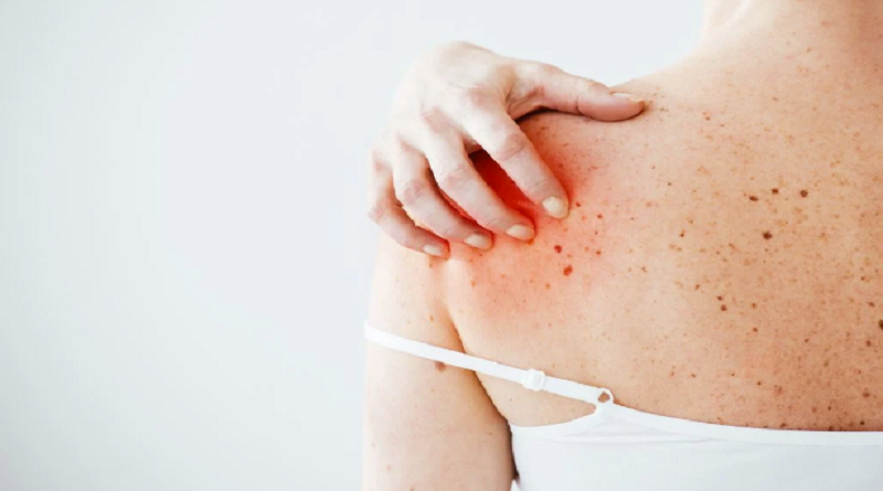 Desarrollan tratamiento que elimina células cancerígenas de la piel en un 100%