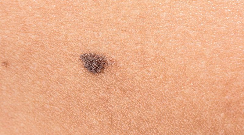 Conoce el software capaz de detectar el cáncer de piel