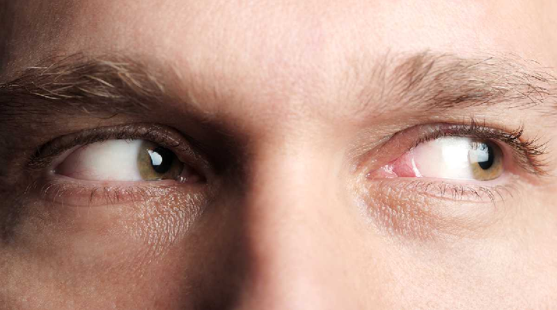¿Cómo afecta el dormir mal a la salud de los ojos?
