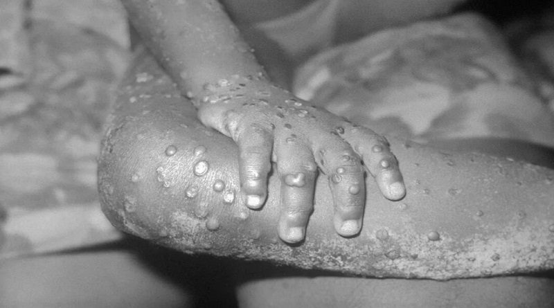 Bolivia intensifica vigilancia epidemiológica ante el primer caso de viruela del mono
