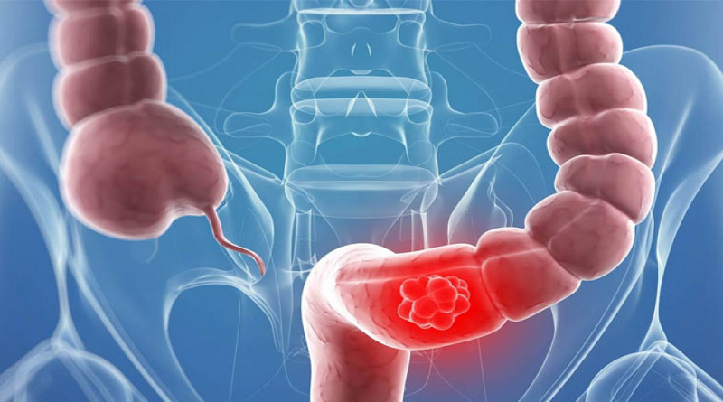 Cáncer de colon