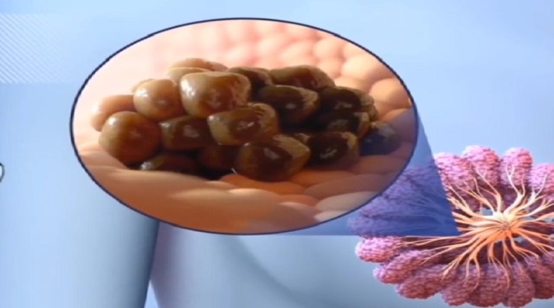 Cáncer de mama: enfermedad que también afecta a los hombres