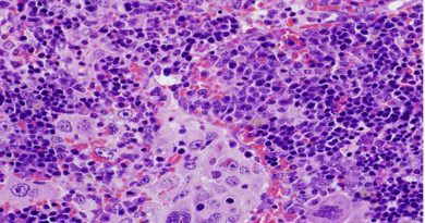 Descubren mutación genética clave en la aparición de linfomas y cáncer de pulmón