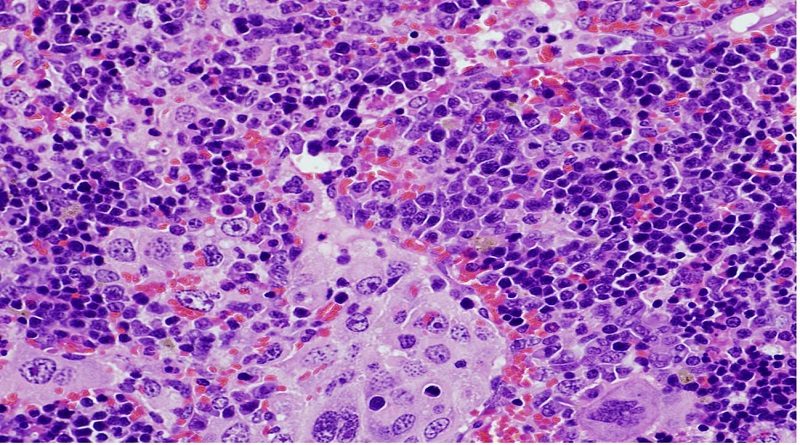 Descubren mutación genética clave en la aparición de linfomas y cáncer de pulmón
