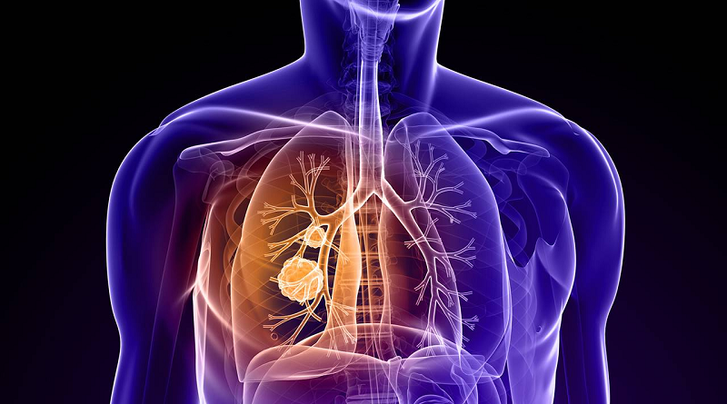 Estas son las principales señales de alarma del cáncer de pulmón