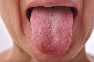 Conoce las principales causas de la Halitosis 2