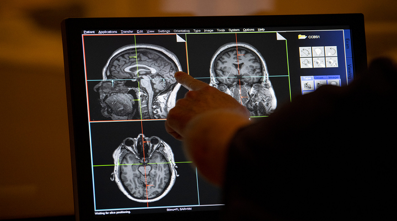 Conozca algunos consejos para cuidar la salud del cerebro
