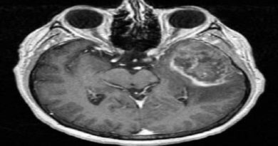 Identifican un nuevo biomarcador en tumor cerebral más letal