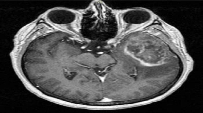 Identifican un nuevo biomarcador en tumor cerebral más letal