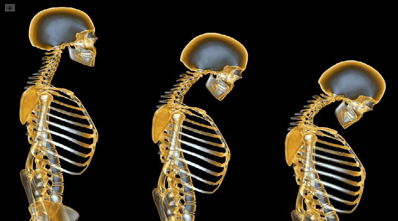 Revelan que la contaminación del aire de EE.UU. representa riesgo de padecer osteoporosis