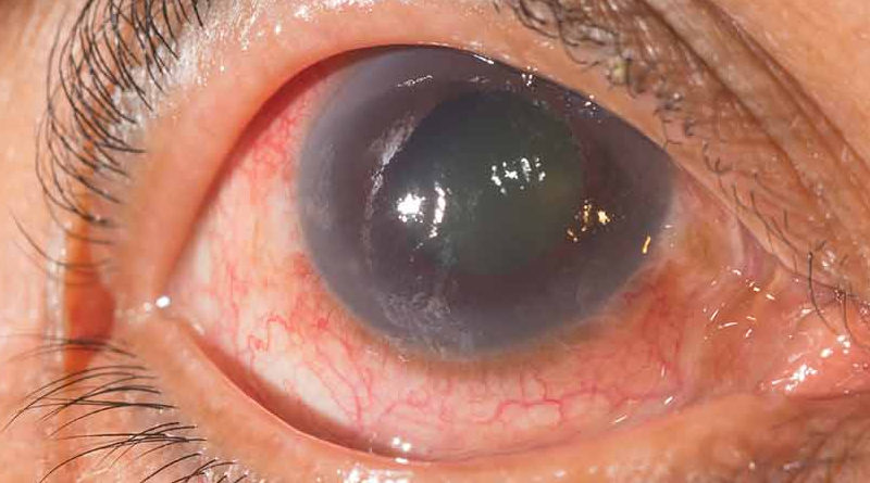 Conozca cómo prevenir el glaucoma