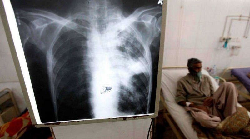 OPS alerta sobre avance de casos de tuberculosis en las Américas