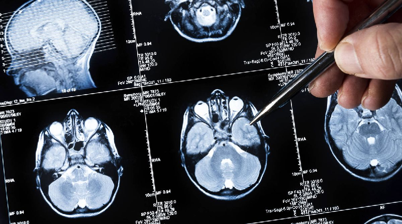 Estudio demuestra lo que ocurre en el cerebro antes de fallecer