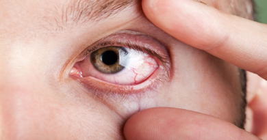 Cómo diferenciar la alergia ocular del ojo seco