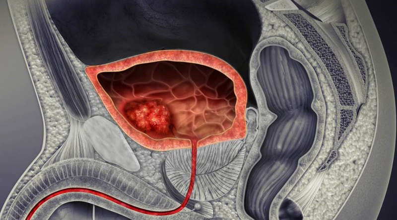Pérdida del cromosoma Y favorece el crecimiento del cáncer