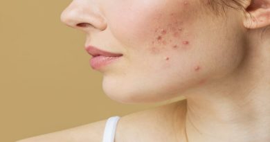 ¿Qué hace la vitamina C en el rostro cuando se sufre de acné?