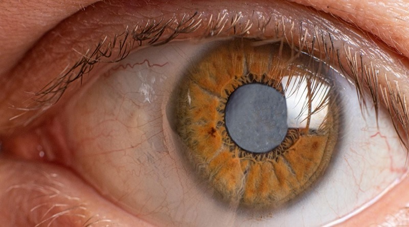 ¿Qué es el glaucoma y cómo evitarlo?
