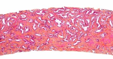 Transformación de grasa blanca en parda puede prevenir el cáncer de próstata