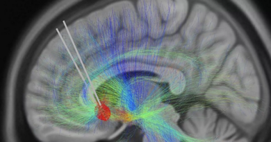 IA identifica señales cerebrales vinculadas a recuperación de la depresión