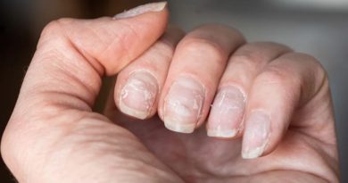 Cambios irregulares en las uñas que llegan a causar enfermedades