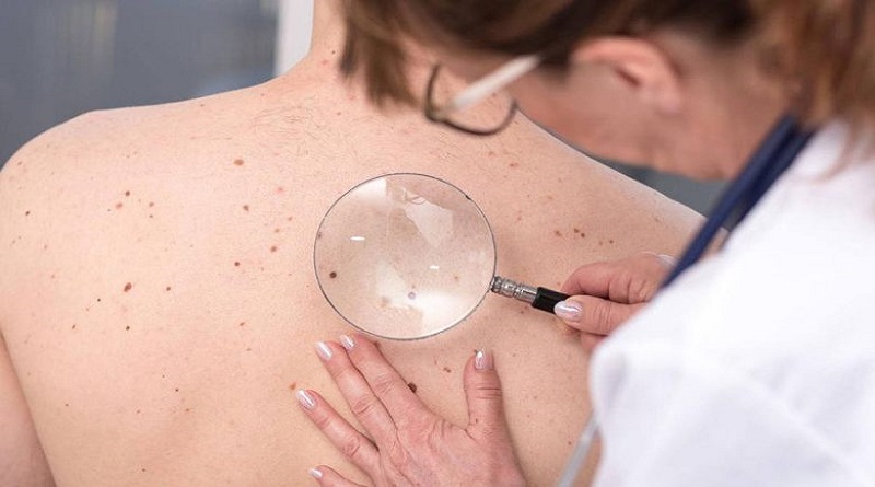 El melanoma rompe genes para resistir a la acción de los fármacos