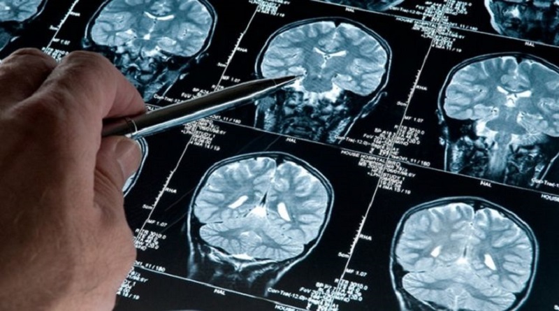Desarrollan en España una IA que precisa el padecimiento de Alzheimer