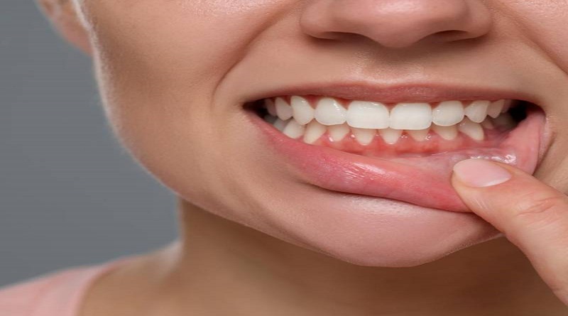 Diez mitos de la salud de las encías