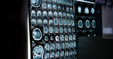 Escaneo cerebral promete detectar demencia años antes de los síntomas
