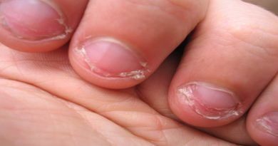 La onicofagia y la salud dental