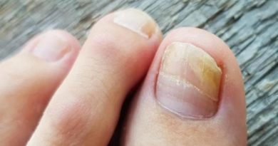 ¿Qué el es hongo en las uñas y como combatirlo
