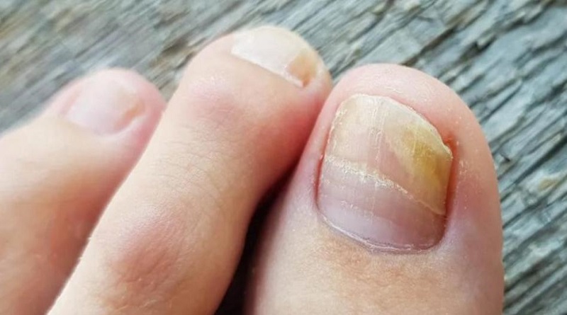 ¿Qué el es hongo en las uñas y como combatirlo