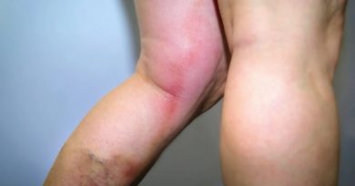 Conoce que es la tromboflebitis, sus síntomas y causas