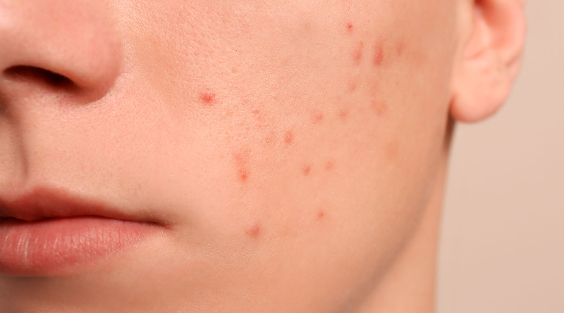 ¿Cómo prevenir las manchas del acné?