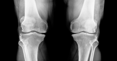 Nuevo tratamiento promete avances en lucha contra osteoporosis