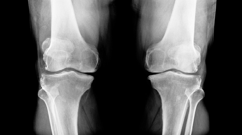 Nuevo tratamiento promete avances en lucha contra osteoporosis